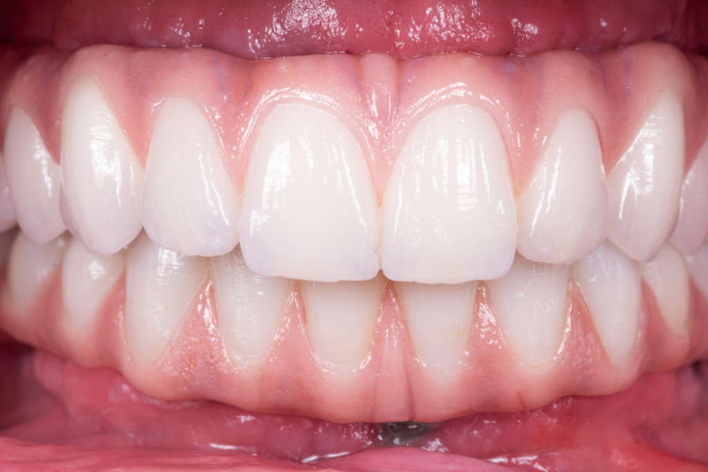 All-on-4 - oralrehablosalgodones.com